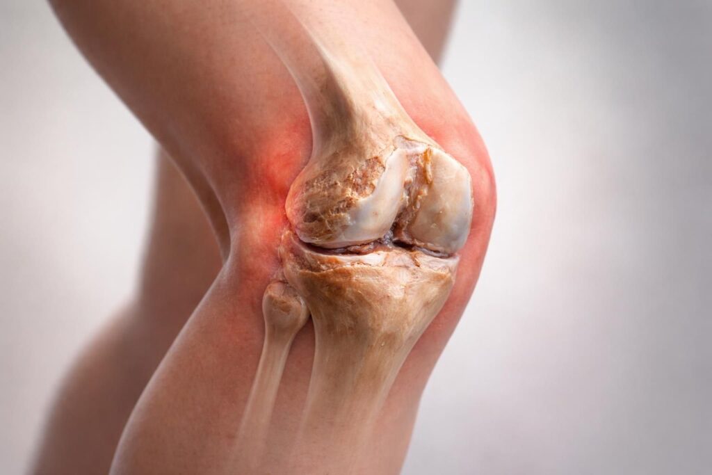 découvrez comment identifier les symptômes de l'arthrose du genou pour agir avant l'usure avancée et préserver votre mobilité.
