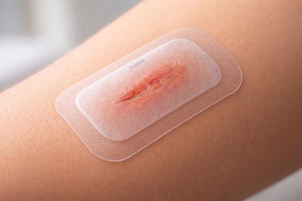 découvrez comment le patch eryplast favorise la cicatrisation des plaies en protégeant la peau et en accélérant le processus de guérison.